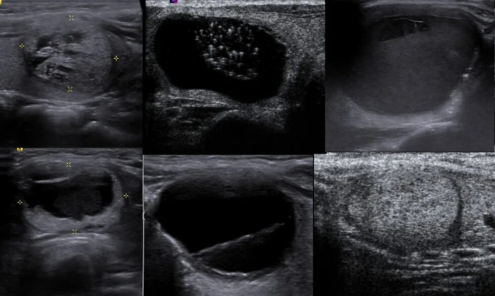 Кистозно расширенная железа. Губчатый узел щитовидной железы на УЗИ. Гиперэхогенный узел в щитовидной железе УЗИ. Кистозно-солидный узел щитовидной железы на УЗИ. Тирадс 5 щитовидной железы УЗИ.