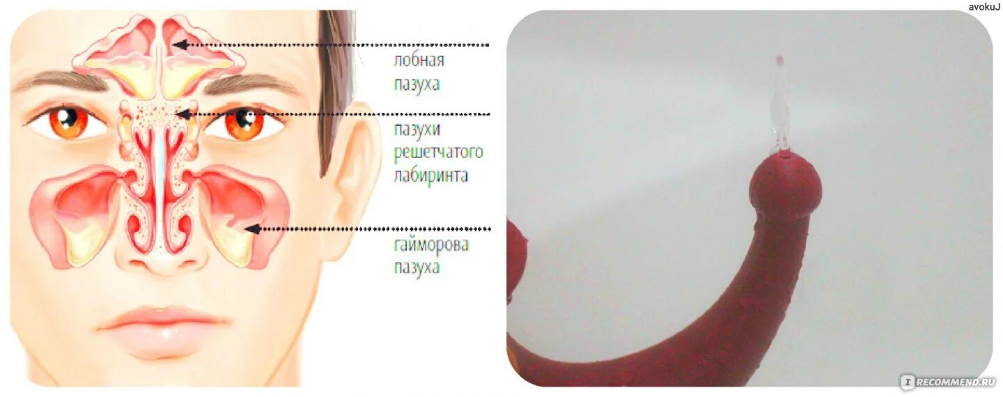 Почему сопли пахнут. Строение носа при насморке. Строение носа и пазух промывание. Строение носа человека при рините.