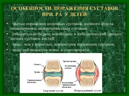 Суставы исключения при ревматоидном артрите