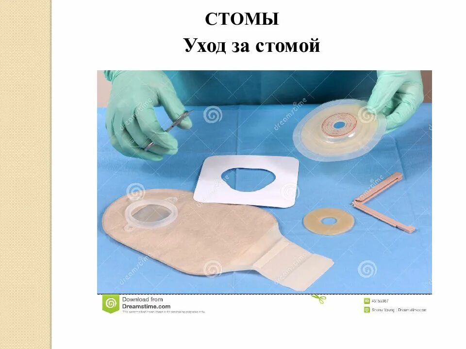 Искусственная стома