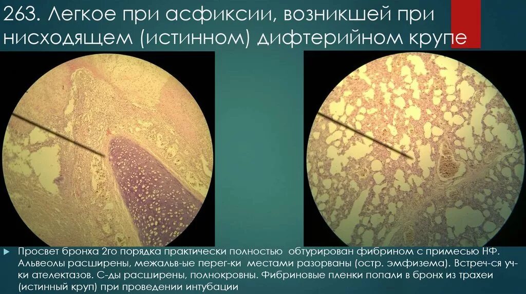 Истинный дифтерийный круп. Истинный дифтерийный круп микропрепарат. Истинный круп при дифтерии микропрепарат. Легкое при асфиксии возникшей при дифтерийном крупе. Осложнение крупа