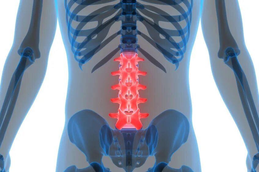Радикулит поясница. Радикулопатия с4. Дискогенная пояснично-крестцовая радикулопатия. Люмбалгия и радикулопатия. Люмбаго поясничного отдела позвоночника симптомы.