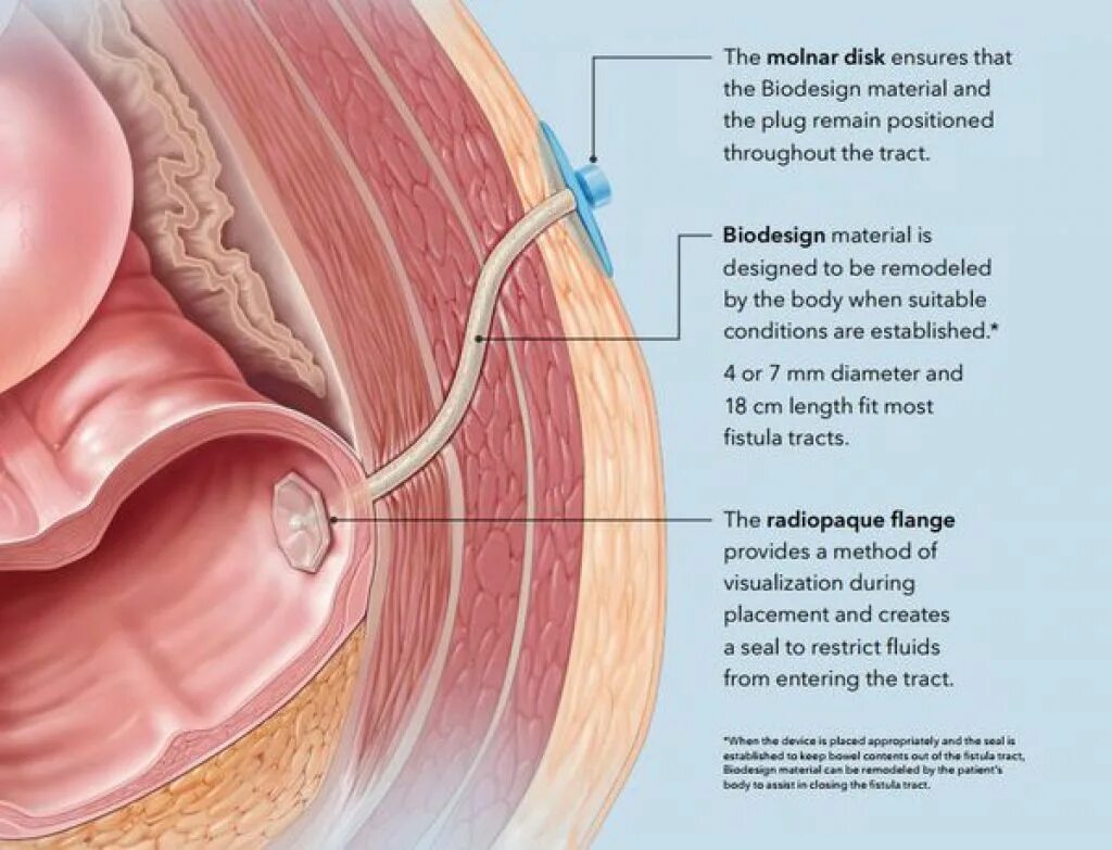 причины возникновения свищей. экстрасфинктерные свищи прямой кишки. сформированный трубчатый кишечный свищ. свишь свишь это что такое. свишь свишь это что такое.