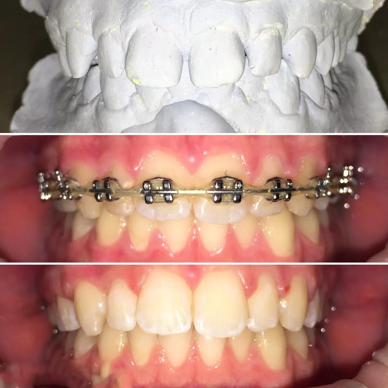 Во сколько можно ставить брекеты ребенку. Красивые детские брекеты. Во сколько можно ставить брекеты ребенку. Брекеты на маленьких зубах. Во сколько можно ставить брекеты ребенку.