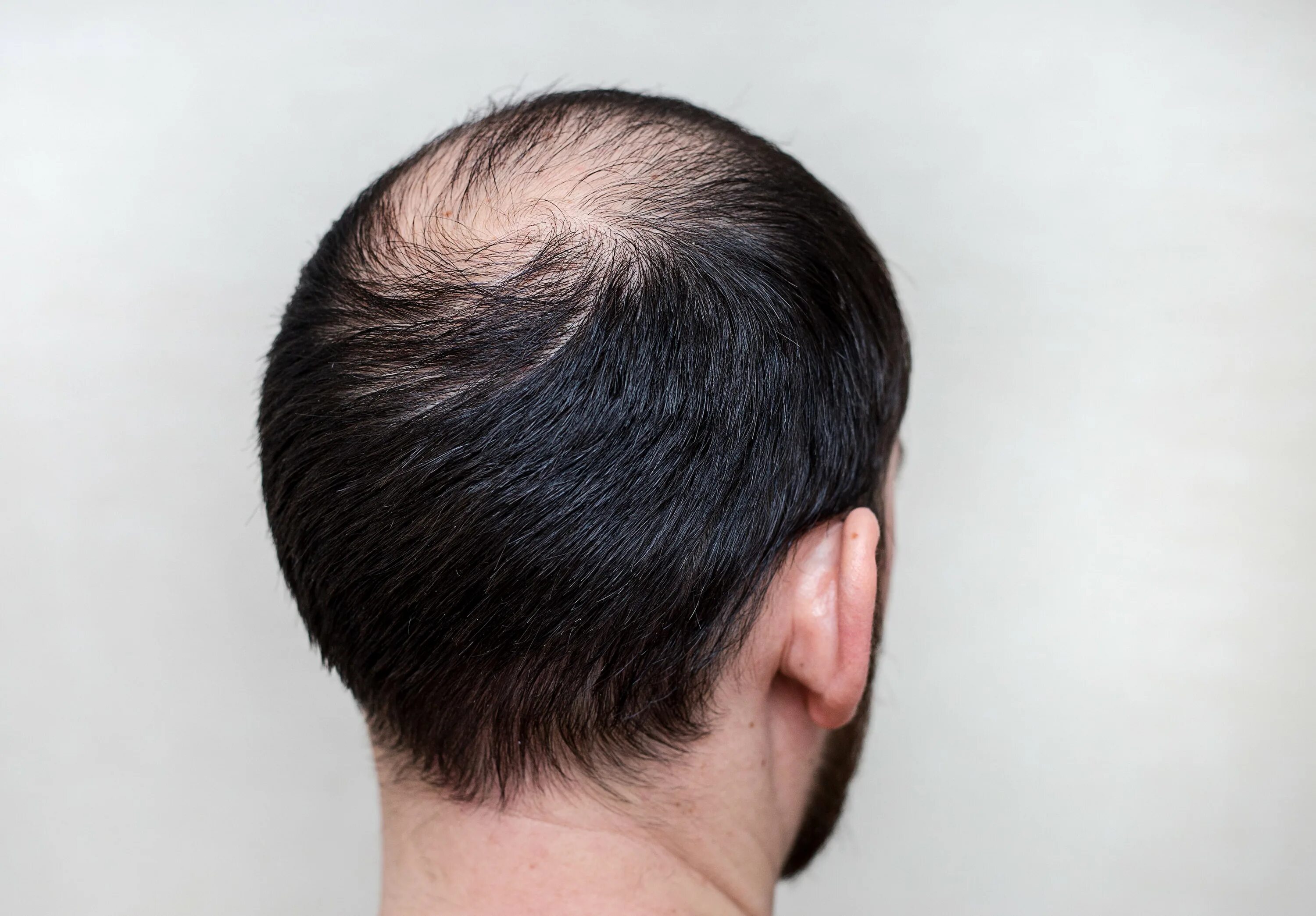 Очаговая алопеция (alopecia Areata). Андрогенетическая алопеция у мужчин.