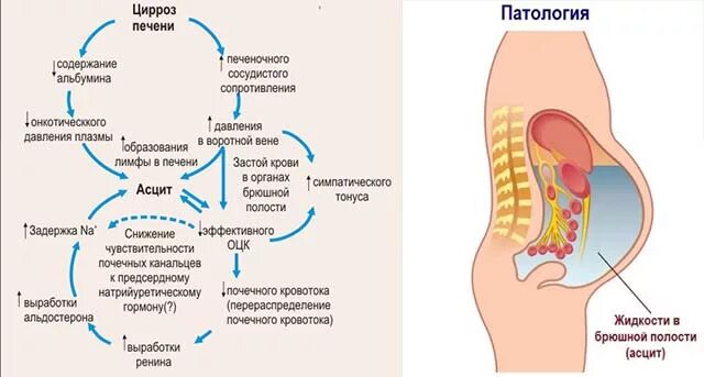 Накопление жидкости в брюшной полости. Жидкость в брюшной полости (асцит). Скопление жидкости в брюшной полости причины. Застой воды в организме