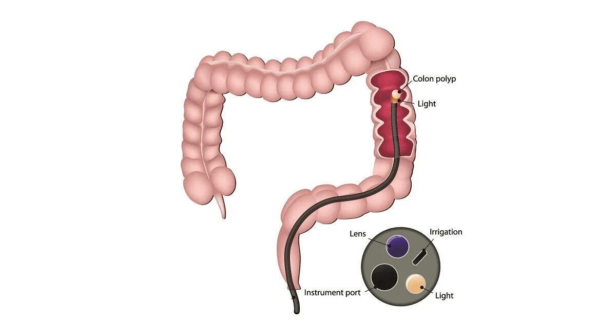 Длина колоноскопии. Колоноскопия кишечника схема кишки. Путь продвижения эндоскопа при колоноскопии схема. Колоноскопия кишечника схема проведения. Строение кишечника колоноскопия.