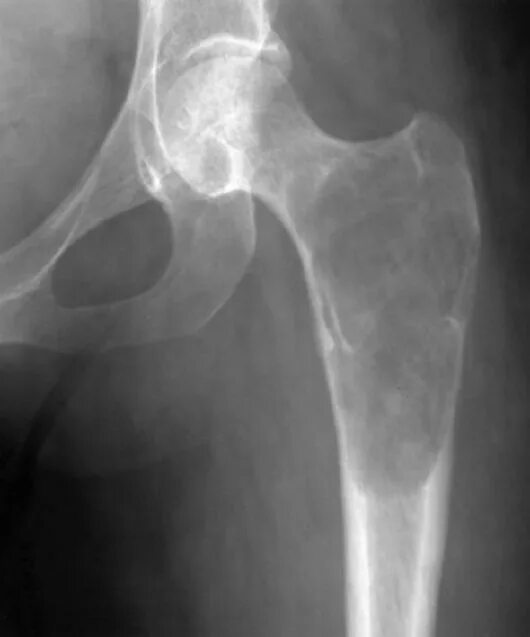 Остеосаркома тазобедренного сустава на рентгене. Хондросаркома бедренной кости. Саркома тазобедренного сустава рентген. Саркома Юинга бедренной кости рентген. Отек шейки бедра
