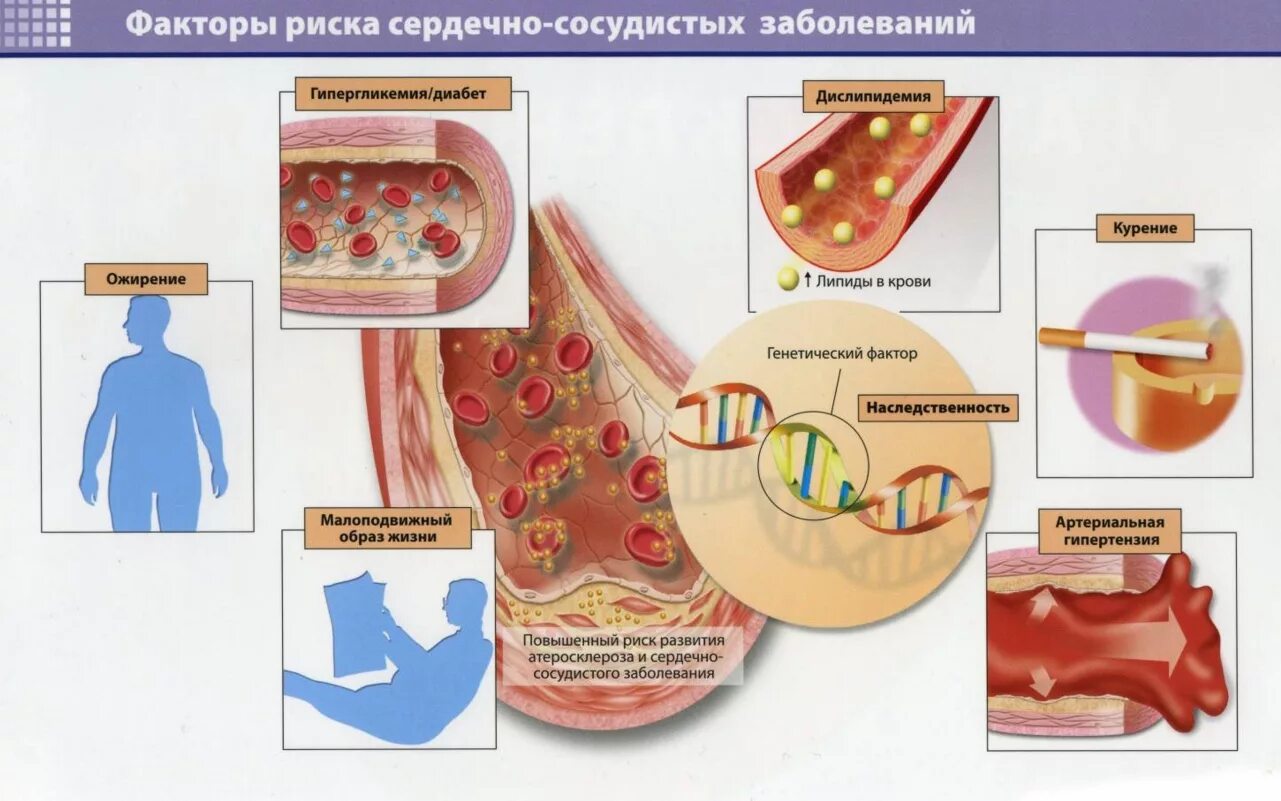 Факторы возникновения атеросклероза. Атеросклероз это простыми словами. Основные заболевание сосудов. Заболевания связанные с сосудами. Основные заболевание сосудов.