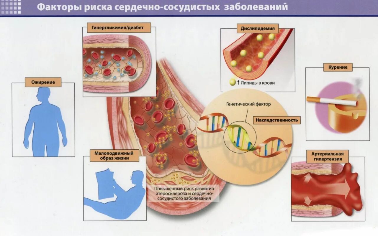 Ожирение и сердечно сосудистые заболевания. Дислипидемия фактор риска атеросклероза. Атеросклероз коронарных артерий факторы риска. Факторы риска развития атеросклероза сосудов:. Факторы риска атеросклероза и и ишемической болезни.