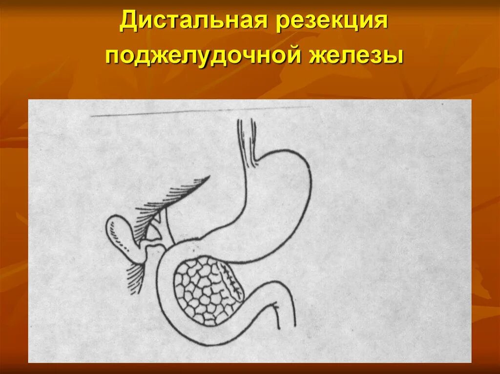 Делают ли операцию на поджелудочную. Дистальная субтотальная резекция. Дистальная (левосторонняя) резекция поджелудочной железы. Субтотальная резекция поджелудочной железы. Корпорокаудальная (дистальная) резекция.