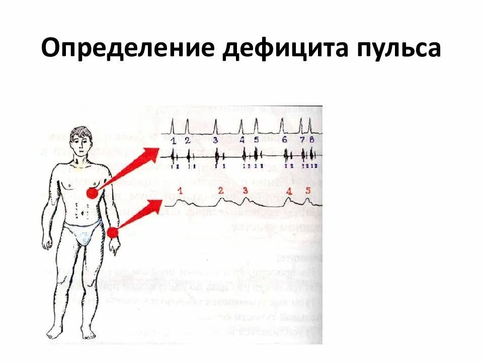 Пульс определяется. Пульс определяется