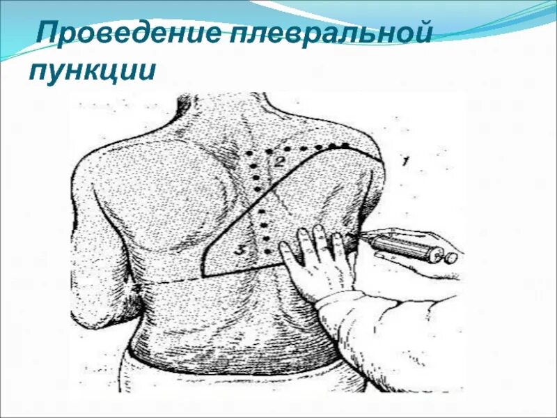 Техника выполнения плевральной пункции. Техника пункции при гидротораксе и пневмотораксе. Техника плевральной пункции при гидротораксе и пневмотораксе. Техника проведения плевральной пункции при пневмотораксе. Пункция плевральной полости при пневмотораксе техника.