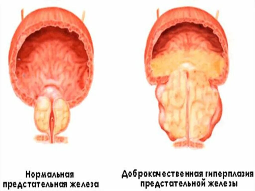 Гиперплазия простаты что это такое