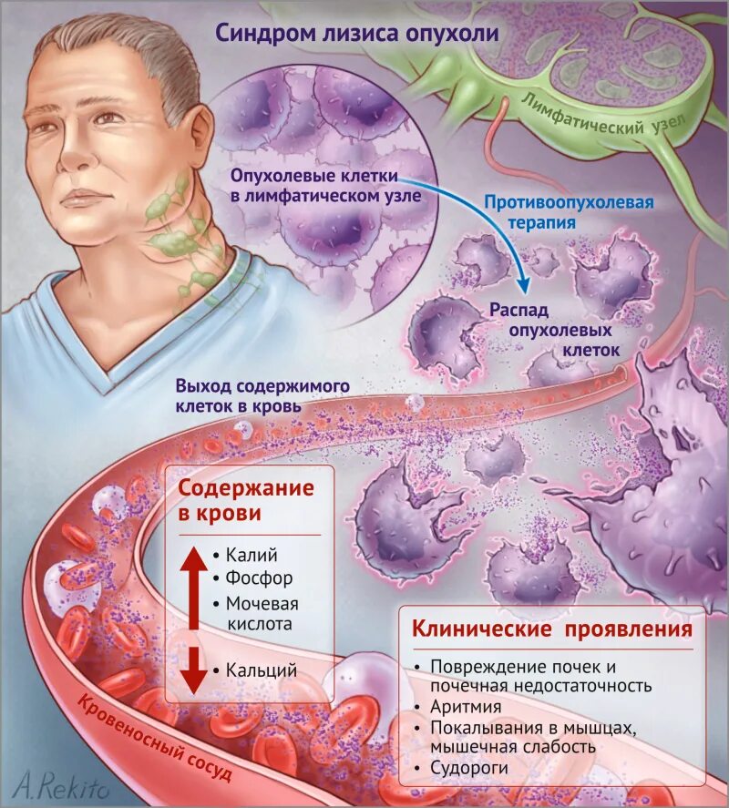 Признаками распада. Синдром острого лизиса опухоли. Синдрому опухолевого лизиса. Синдром распада опухоли.