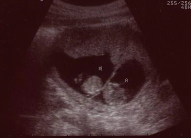 УЗИ 10 недель беременности двойня. Фото УЗИ двойни на 10 неделе беременности. УЗИ 13 недель беременности двойня.