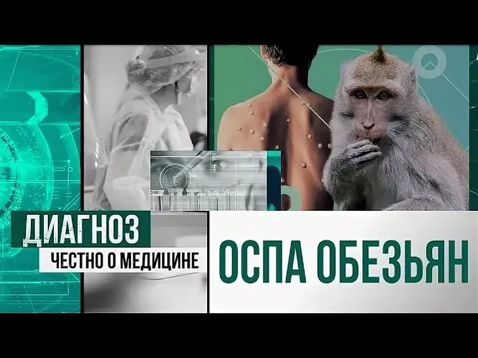 Россия 24 оспа. Диагностика оспы обезьян. Симптомы оспы обезьян у человека. Оспа обезьян пути передачи.