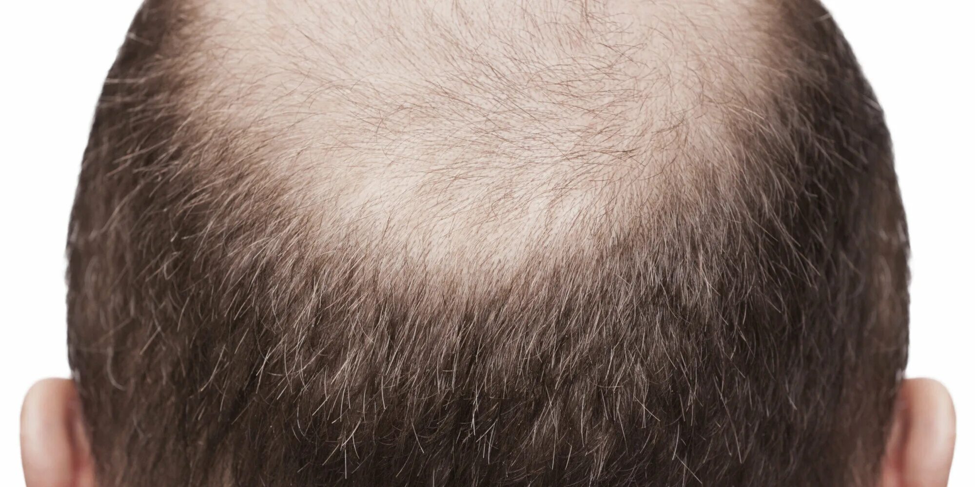 Прогалина на голове мужчины. Очаговая алопеция (alopecia areata). Короткая стрижка с залысинами. Мужское облысение. Лысина на макушке у мужчин.