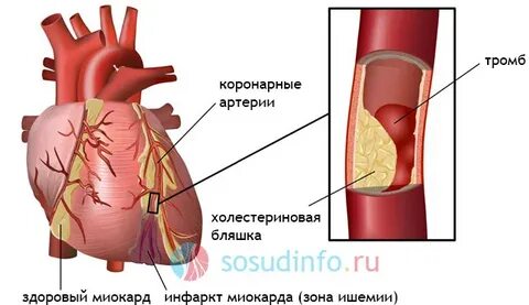 Тромб после инфаркта