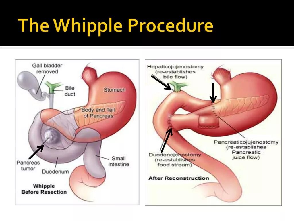 Пдр операция. Уиппла операция Уиппла. Панкреатодуоденальная резекция операция Whipple. Операция Уиппла Блэкмора. Панкреатодуоденальная резекция Уиппла.