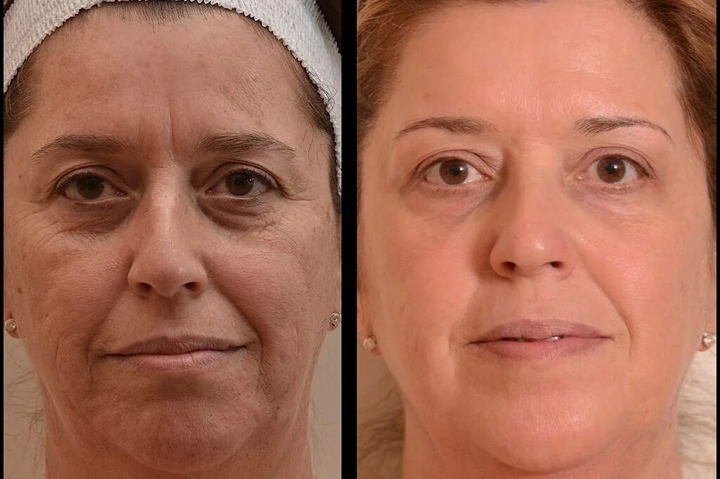 ДМАЕ вокруг глаз мезотерапия. Омоложение лица до и после. Мезотерапия лифтинг до и после. Морщины до после.