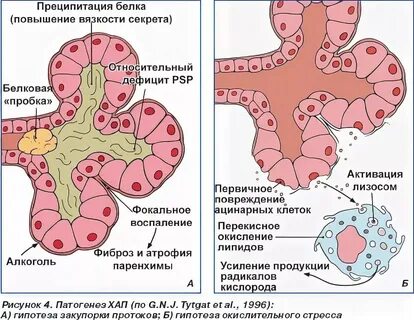Панкреатит патогенез