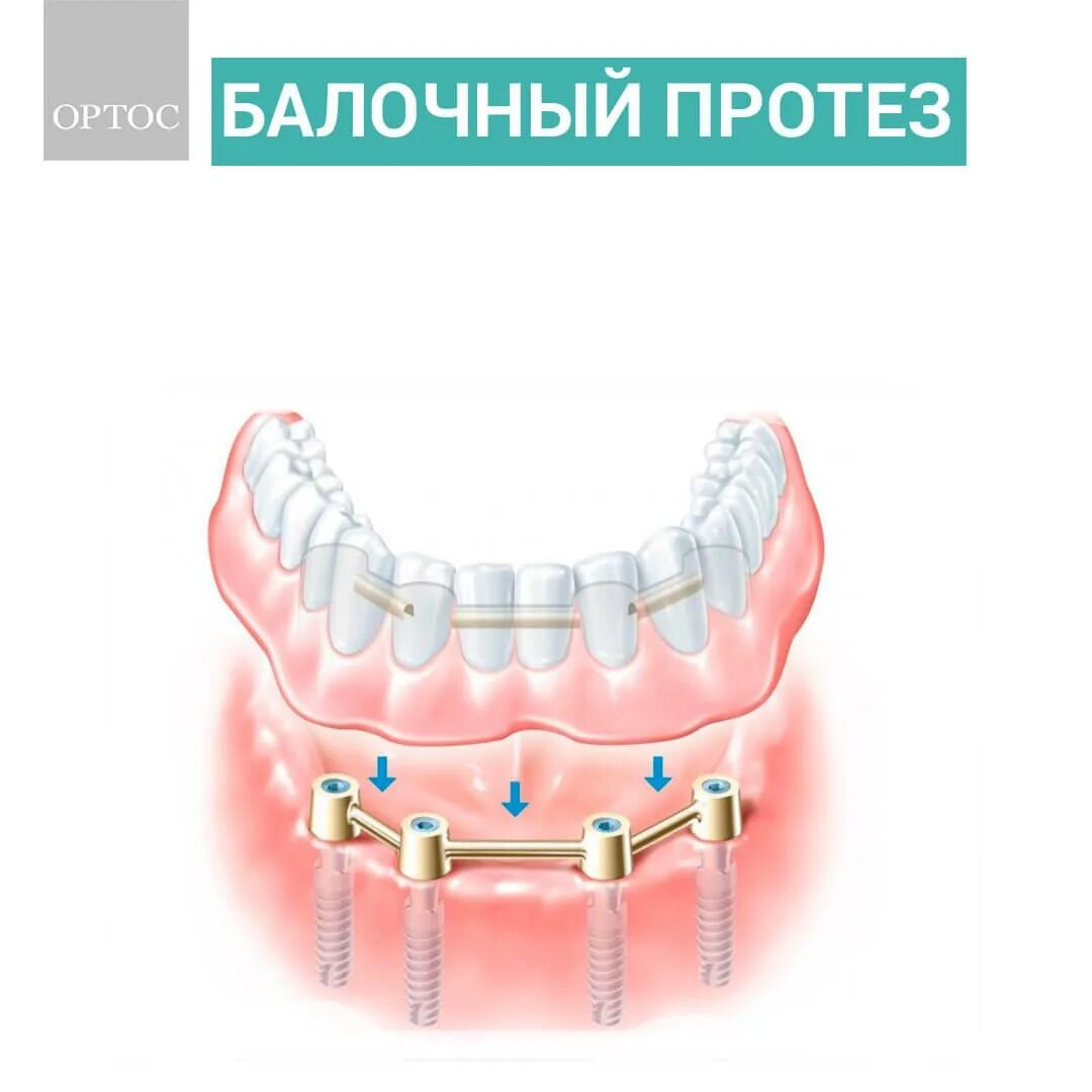 Балочная система фиксации протезов. Балочный протез на 4 имплантах. На 4 имплантах бюгельный протез. Условно-съемные балочные протезы.