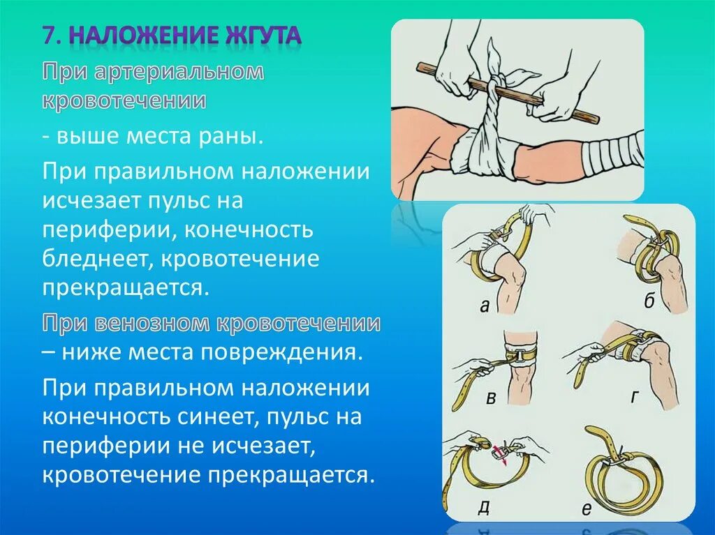 Алгоритм наложения жгута при артериальном кровотечении. Порядок наложения жгута при артериальном кровотечении. Наложение артериального кровоостанавливающего жгута. Места наложения жгута при артериальном кровотечении. Техника наложения артериального жгута при артериальном кровотечении.