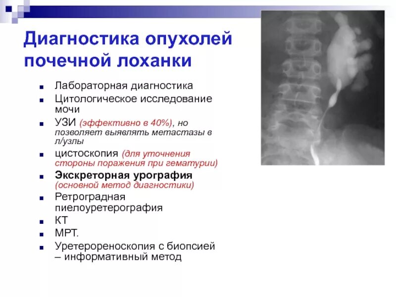 Диагностический метод при подозрении на опухоль почки. Наиболее достоверный метод диагностики опухоли почек.