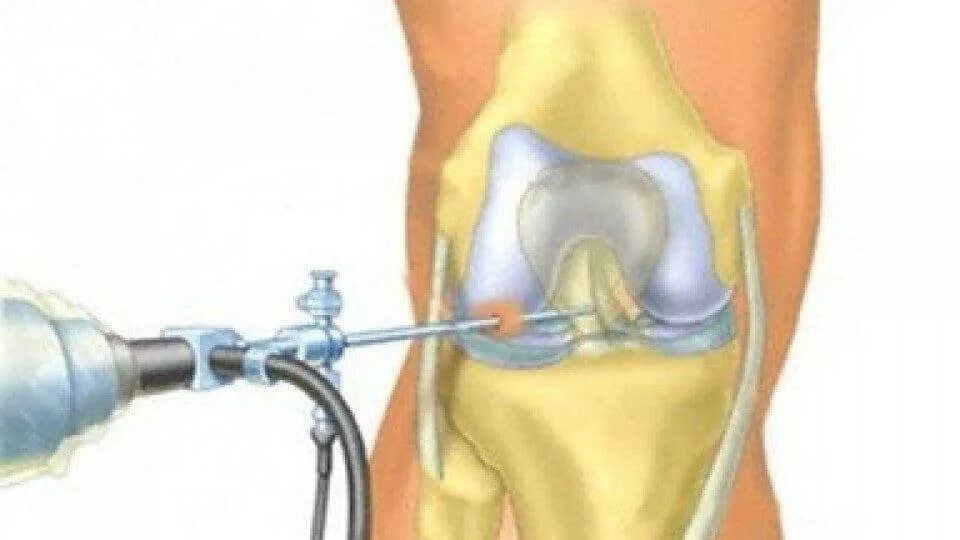 Артроскопия ПКС коленного сустава. Операция артроскопия коленного сустава. Артроскопия связки надколенника. Разрыв мениска артроскопия.