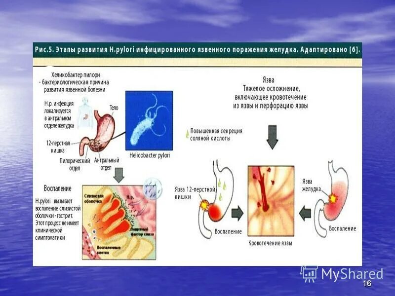 особенности течения язвенной болезни желудка. лечения язвеннойболезниудитей. патофизиологические особенности язвенной болезни. язвенная болезнь педиатрия. язвенная болезнь болезнь желудка и 12 перстной кишки.