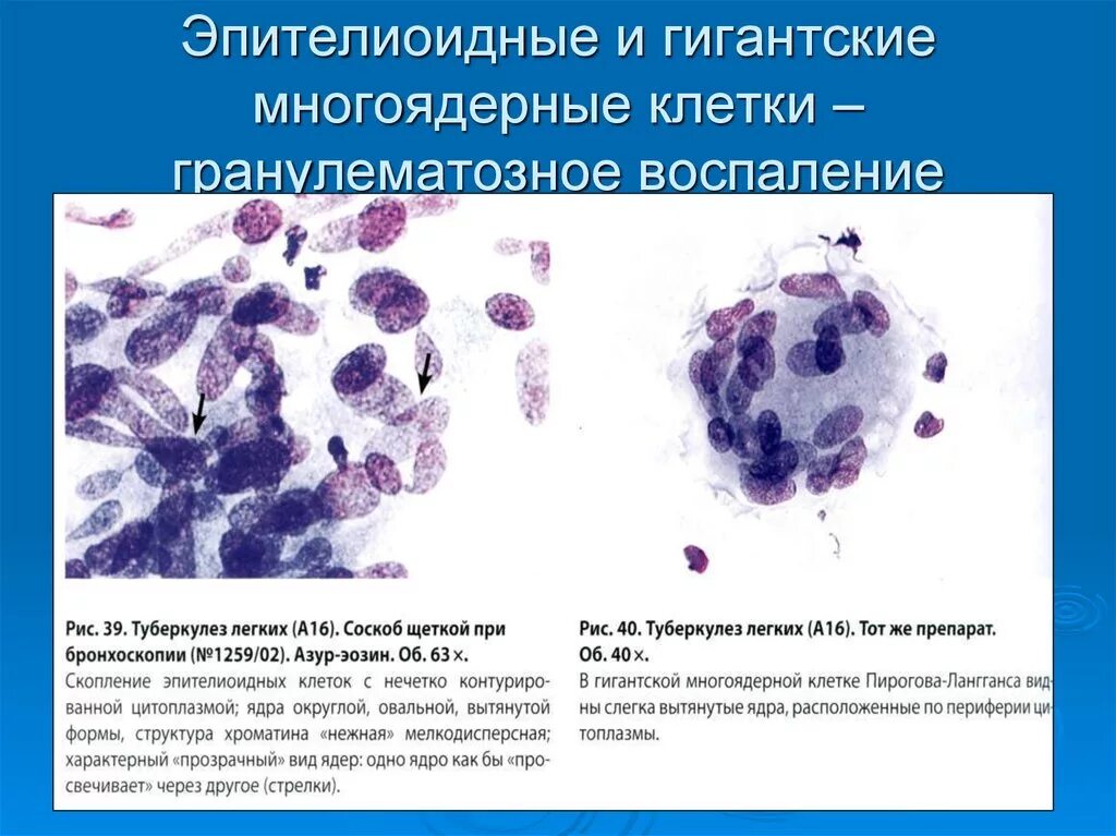 Эпителиоидные макрофаги цитология. Клетки Пирогова Лангханса гистология. Гигантские многоядерные клетки хронического воспаления. Многоядерные клетки гранулема. Отсутствуют клетки с признаками атипии