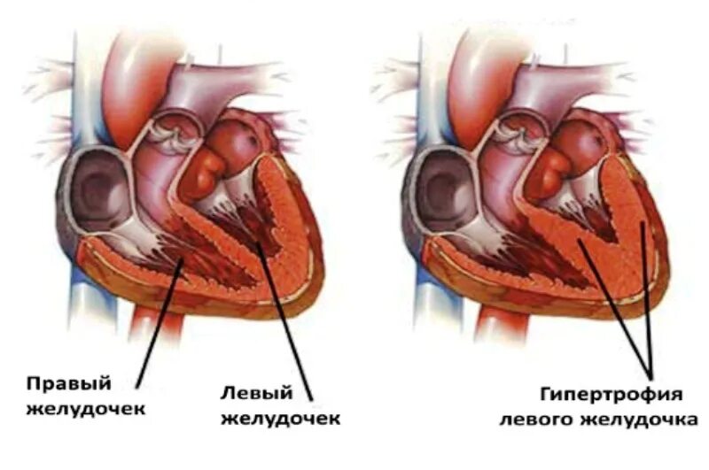 Заболевания левого желудочка. Гипертрофия миокарда левого желудочка. Левый желудочек сердца гипертрофирован. Гипертрофия желудочков сердца — сердце. Гипертрофия левого желудочка сердца при болезни.