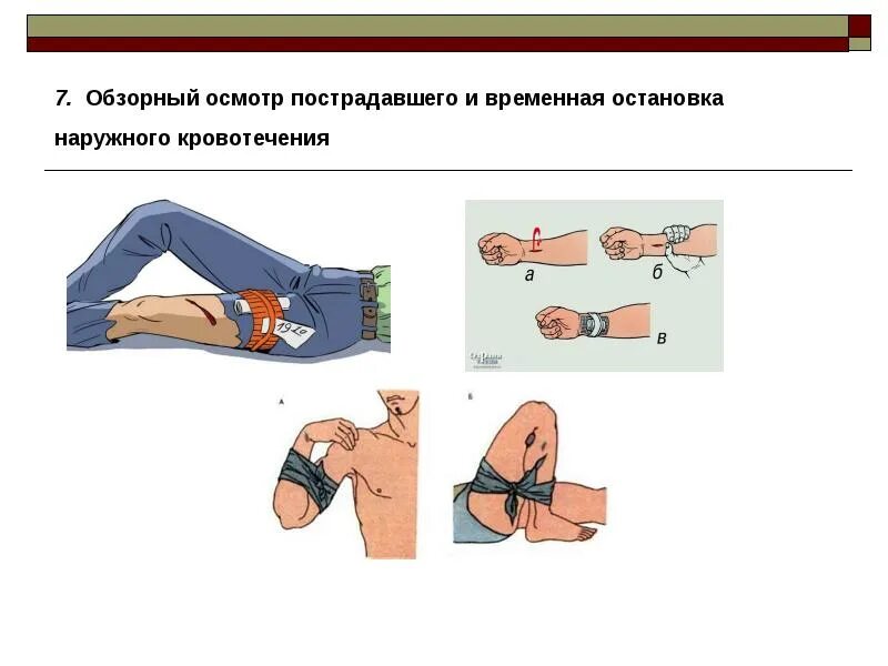 1 осложнения кровотечения. Остановка наружного кровотечения. Кровотечение остановка кровотечения. Способы временной остановки наружного кровотечения. Обзорный осмотр пострадавшего.