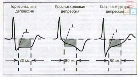 Депрессия зубца