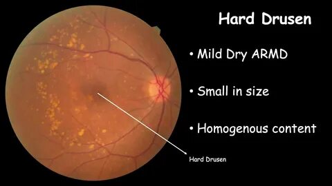 Age related macular degeneration
