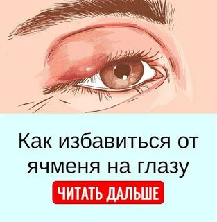 Лезет ячмень