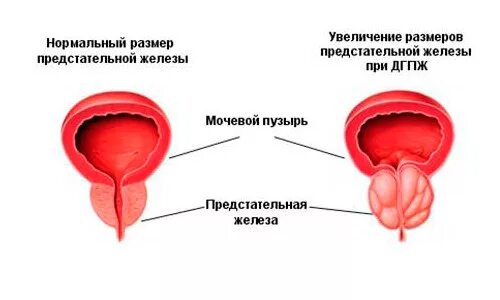 Острые простаты. Гиперплазия предстательной железы. Капсула предстательной железы. Нормальные Размеры простаты.