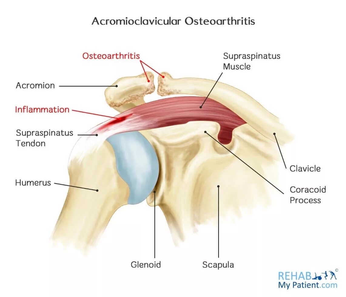 Воспаление акромиально-ключичного сочленения. Акромиально-ключичный сустав мышцы. Артроз акромиально-ключичного сочленения плечевого сустава. Акромиально-ключичный сустав 2 степени.