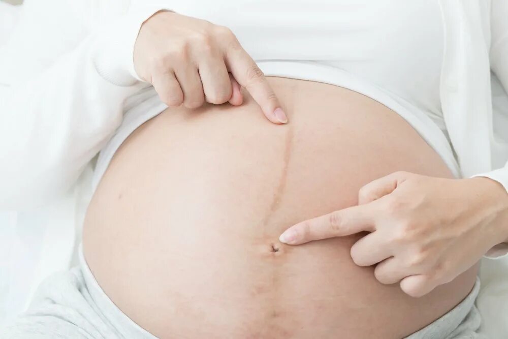 Пигментная полоса на животе. Пигментные пятна у беременных. Пигментация на животе при беременности.