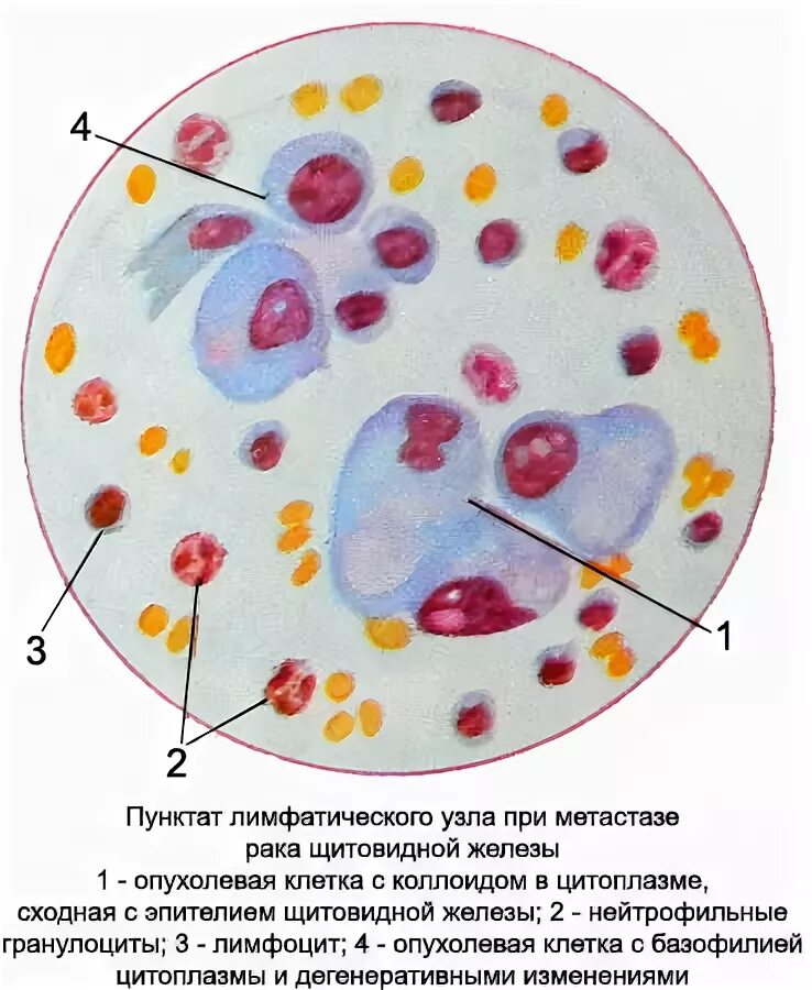 Метастазы при раке щитовидной железы