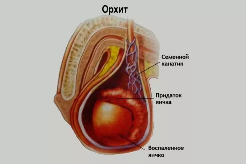 Воспаление придатка яичка симптомы