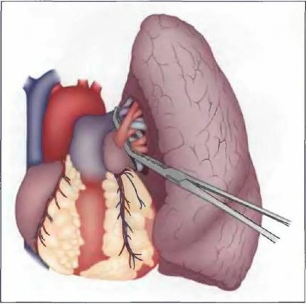 Лобэктомия что это. Видеоторакоскопия резекция легкого. Лобэктомия легкого операция. Торакоскопическая лобэктомия.