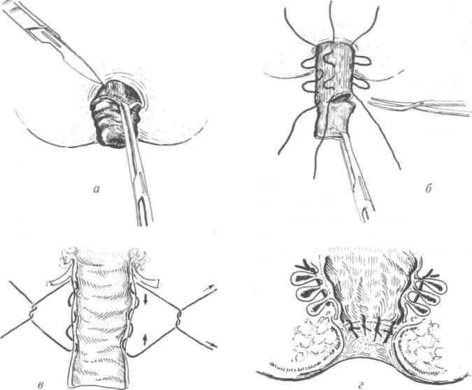 Операция Делорма при выпадении прямой кишки. Операция Тирша при выпадении прямой кишки. Выпадение прямой кишки хирургия. Выпадение прямой кишки схема. Как правильно вставить кишку