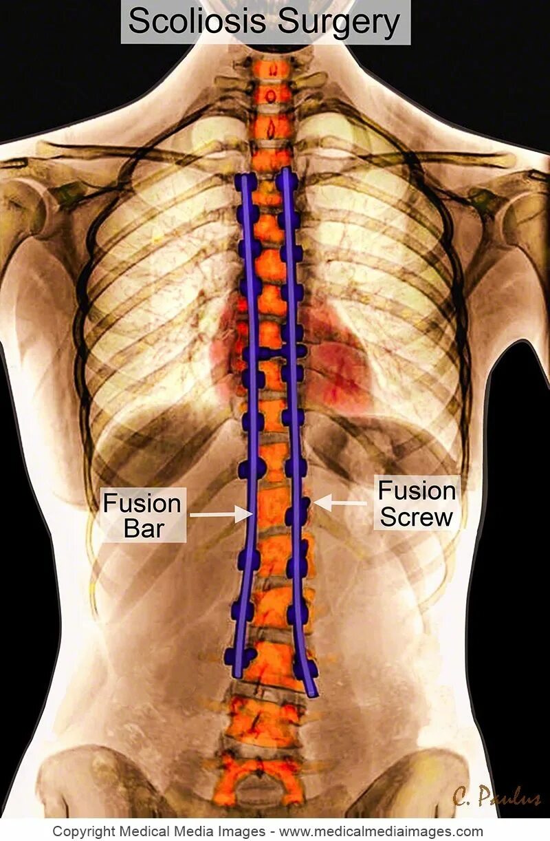 Металлоконструкция в позвоночнике. Сколиоз позвоночника операция. Конструкция позвоночника операция