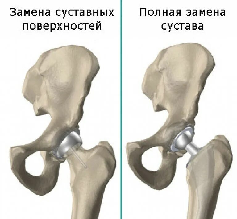 Операция тазобедренный кость