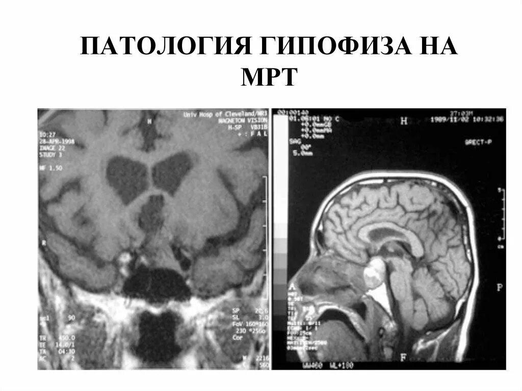 Опухоль гипофиза. Супраселлярная аденома гипофиза мрт. Супраселлярный рост аденомы гипофиза. Аденома гипофиза т1 и т2.