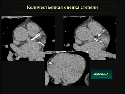 Коронарная кт