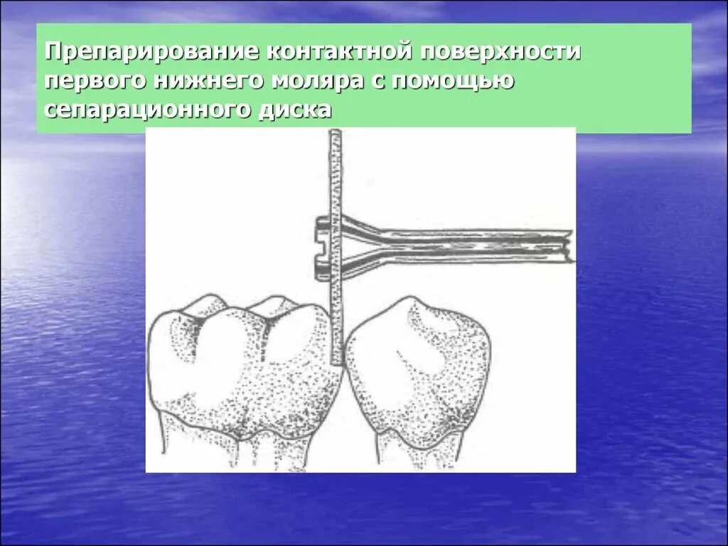 Препарирование это. Препарирование контактной поверхности. контактная поверхность моляров. препарирование нижнего моляра. проксимальная поверхность моляра.
