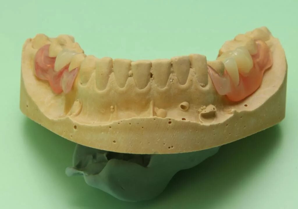 Съемный протез зуба бабочка. Иммедиат протезы показания. Нейлоновый микропротез 1-3 зуба.